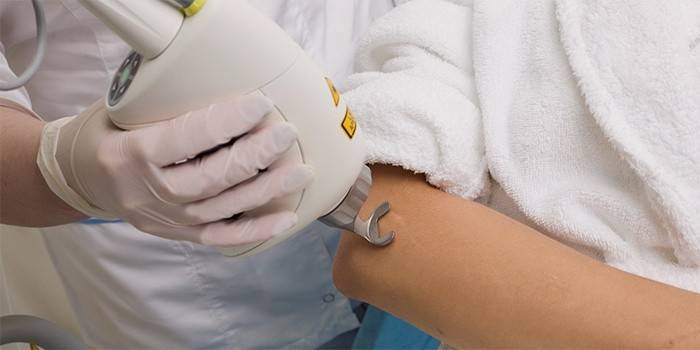 Rimozione della cicatrice cheloide