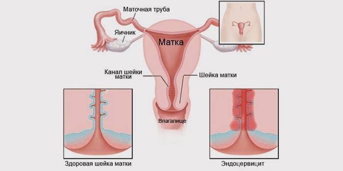 Viêm nội tâm mạc - hậu quả của sự sa tử cung