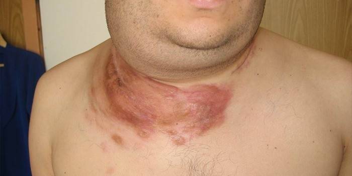 Forma non-Hodgkin - limfomul Burkitt