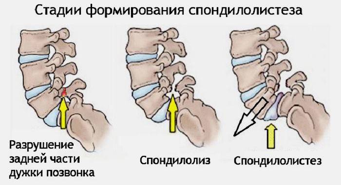Xâm nhập dây thần kinh tọa là kết quả của quá trình tổng hợp cột sống