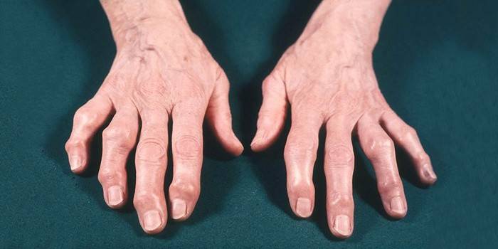 Deforme osteoartroz