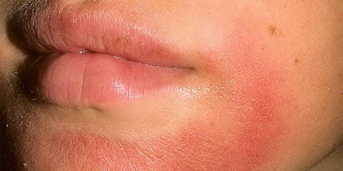 Kontakt dermatitis az arcon