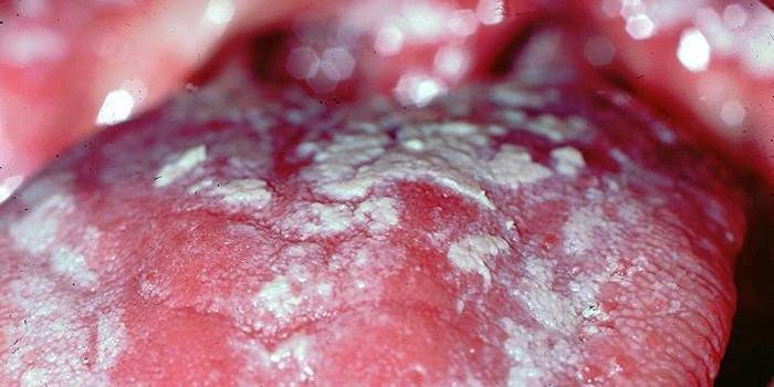 Candida stomatitis