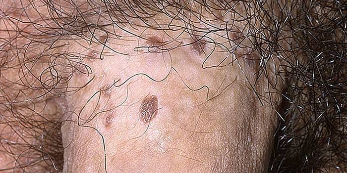 papulosis อวัยวะเพศชาย Bovenoid