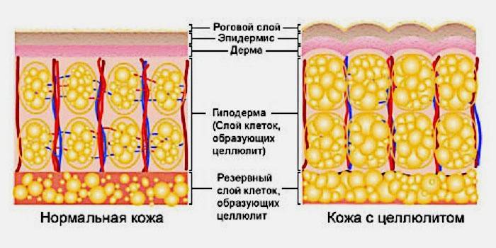 Kas yra celiulitas
