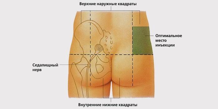 Where to put an injection in the buttock