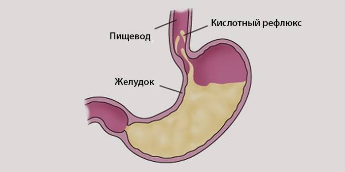 Gastroduodenális reflux