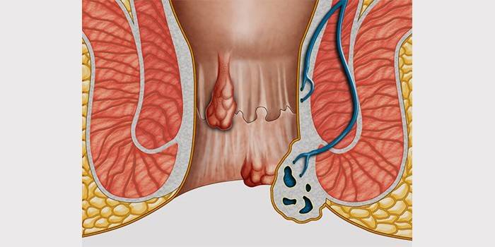 Kombine hemoroid
