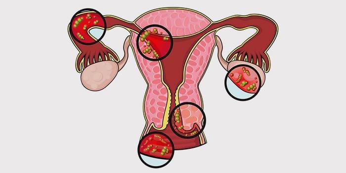 Inflamação genital feminina