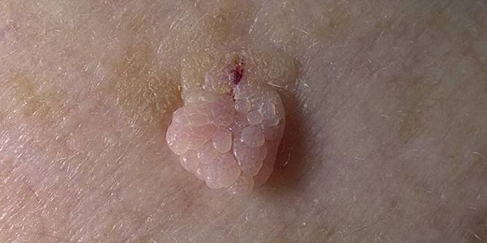 Papilloma incolore di grandi dimensioni