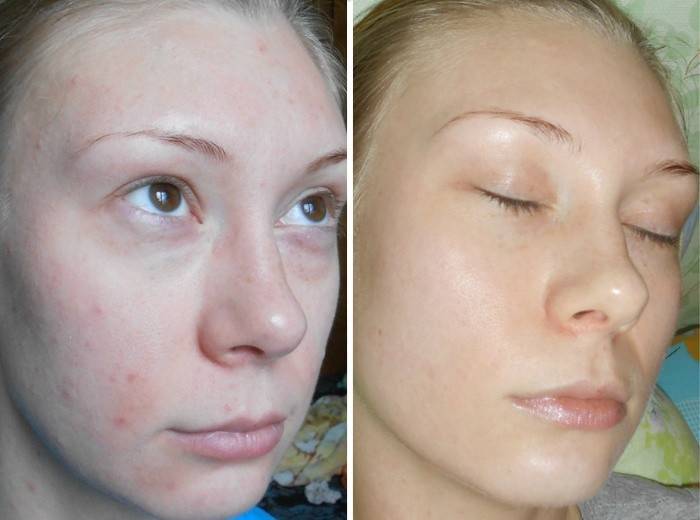 Rezultatul procedurii cu acid glicolic