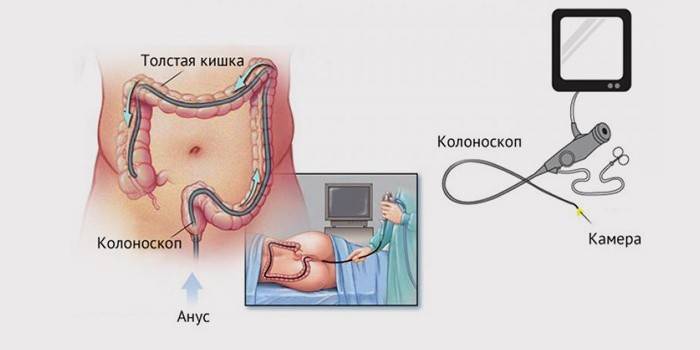 การส่องกล้องตรวจลำไส้ใหญ่ดำเนินการอย่างไร