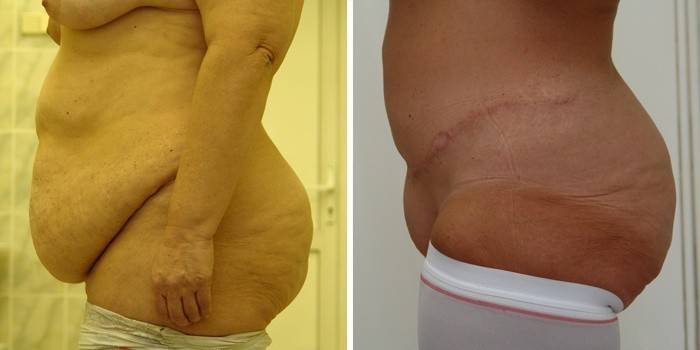 Abdominoplastik Resultat