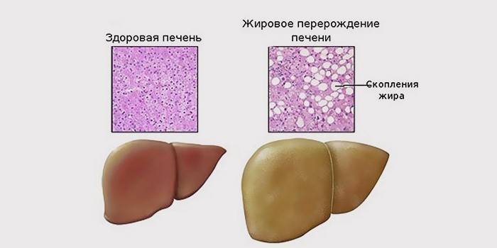 Comparația hepatatozei grase și a ficatului sănătos