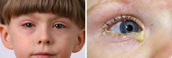 Perte de cils due à des infections oculaires