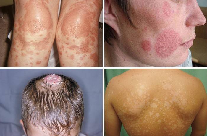Symptômes de pityriasis versicolor
