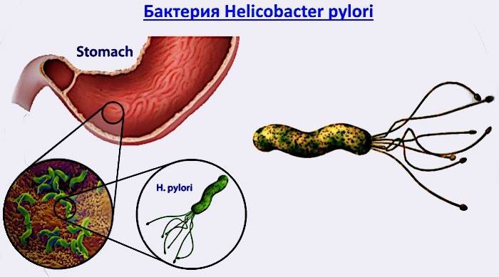Бактерия Helicobacter pylori, причиняваща стомашно заболяване