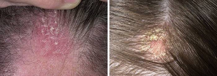 Kløe med seboreisk dermatitis