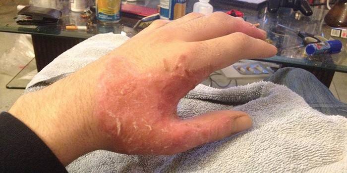 An der Hand eines Mannes brennen