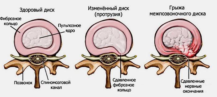 Thoát vị não - nguyên nhân của đau thần kinh tọa