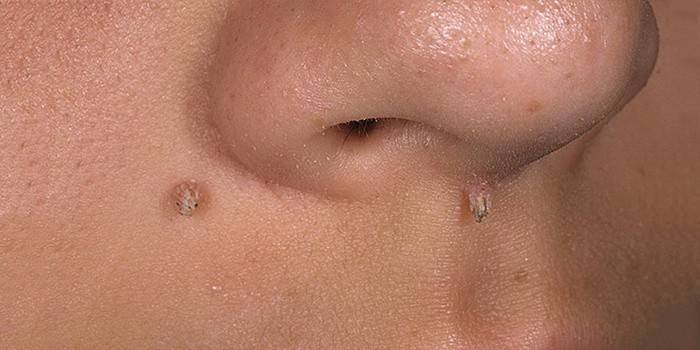 Verruche filamentose
