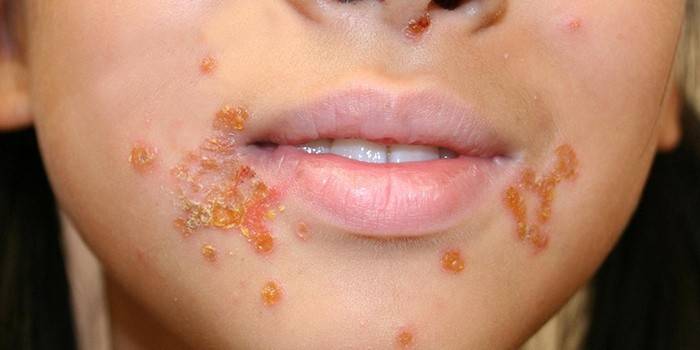 Streptococcus pyoderma gyermekkorban