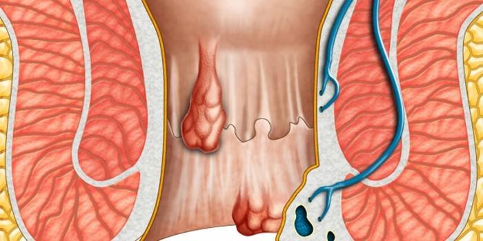 Emorroidi interne