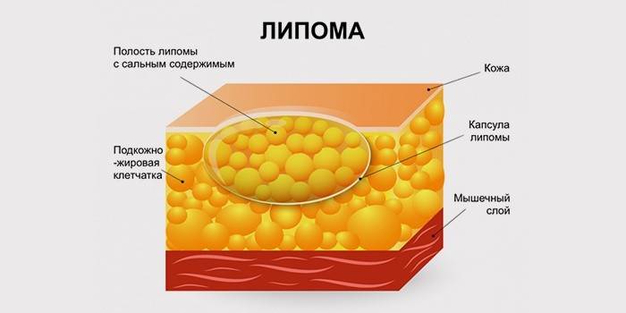 Структура липома