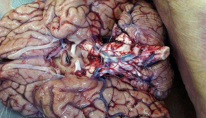 Plăci în arterioscleroza cerebrală