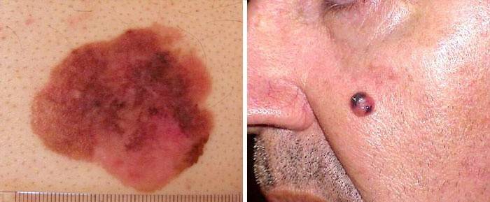 Melanoma iniziale