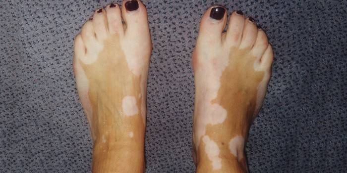 Vitiligo