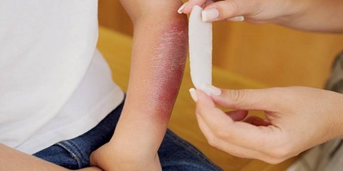 Trattamento delle cicatrici dopo le ustioni con un rimedio popolare