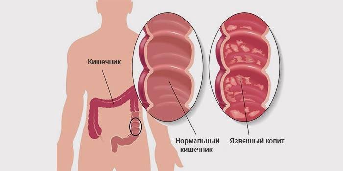 Ilustrație schematică a unui intestin uman sănătos și cu semne de colită ulceroasă