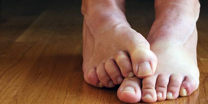 Bàn chân sau khi điều trị bằng iốt