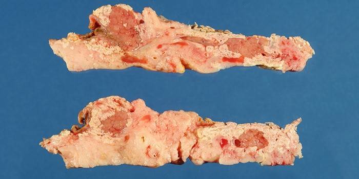 Necrosi pancreatica