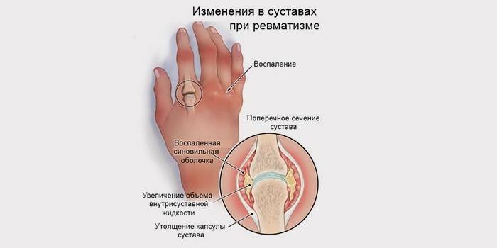 Sự phát triển của viêm khớp dạng thấp
