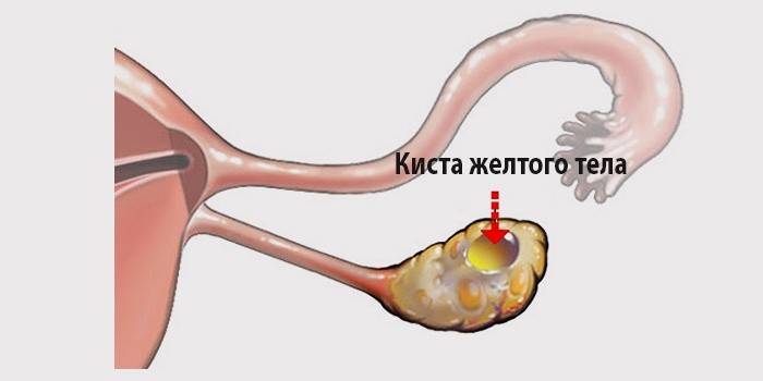 Olnīcu corpus luteum cistas shematisks attēlojums