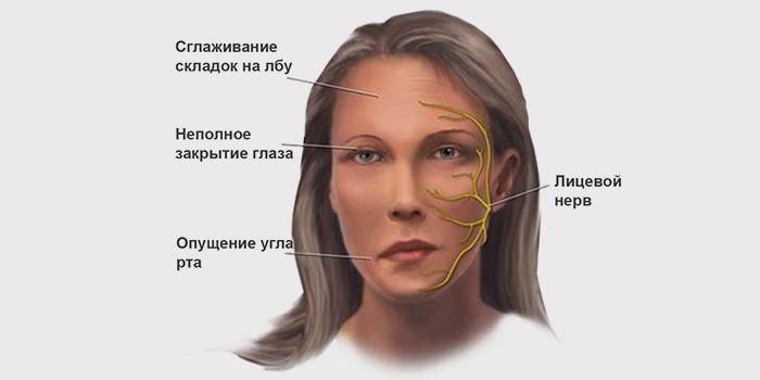 Sintomas de neurite facial