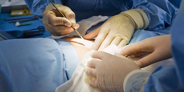 Klassisk abdominoplastik i maven