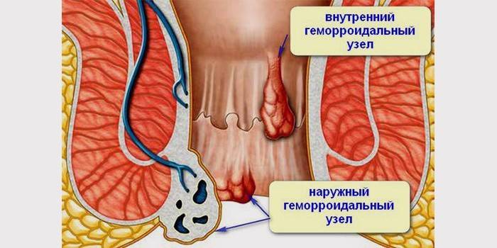 Bệnh trĩ trông như thế nào?