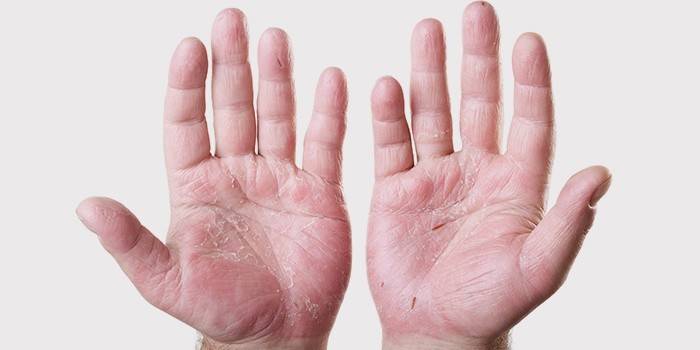 Ekzeme zur Hand