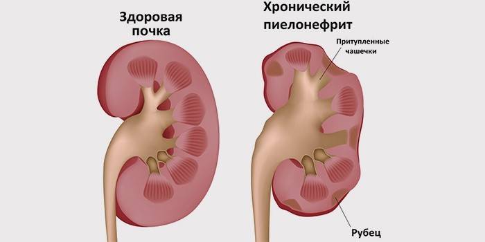 ผู้ป่วยโรคไตและ pyelonephritis