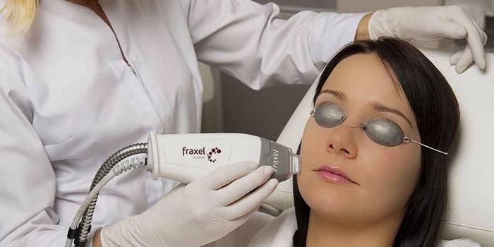 La ragazza fa peeling laser superficiale