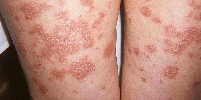 Pityriasis versicolor