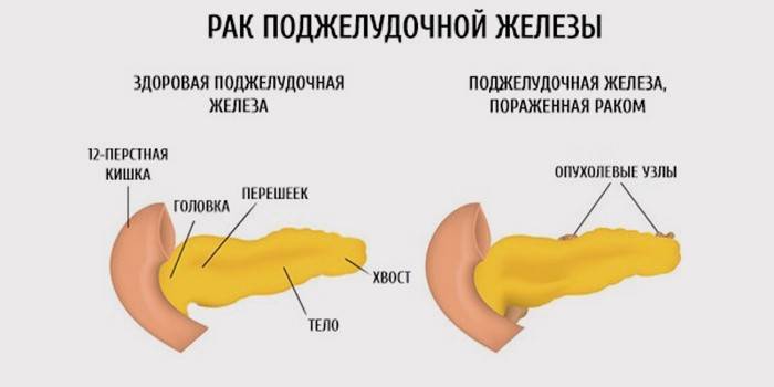 Organ sănătos și bolnav