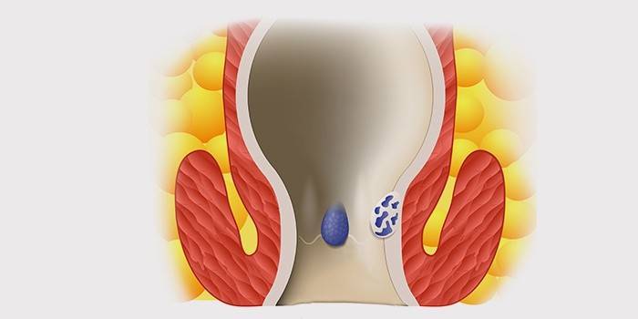 İç hemoroid