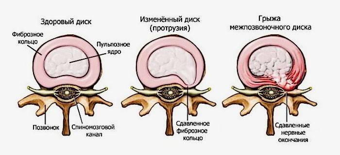 Herniated disk