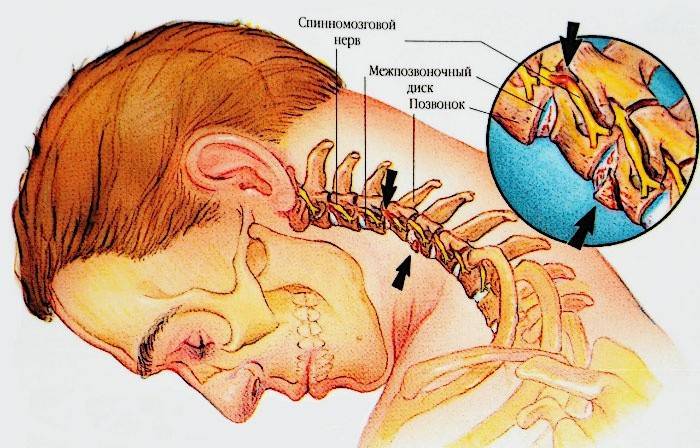 Skema med patologien i livmoderhalsryggen