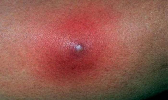 Dideli pūlingi spuogai ant veido