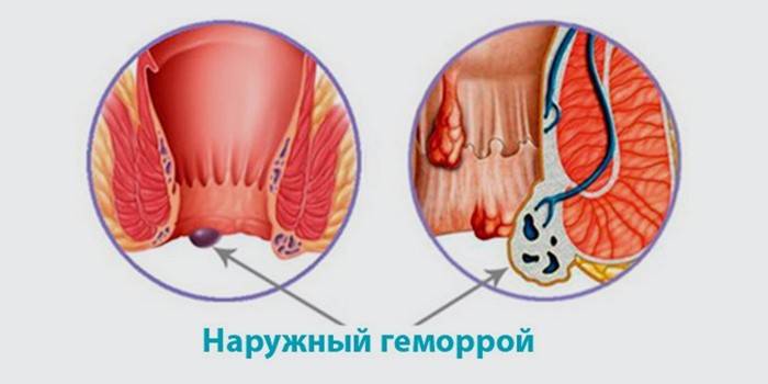 Dấu hiệu bệnh trĩ ngoại